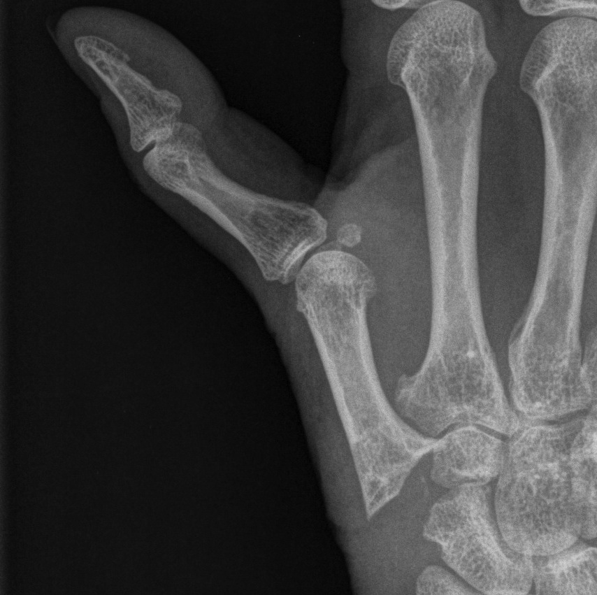 Rheumatoid Swan Thumb Trapeziectomy 